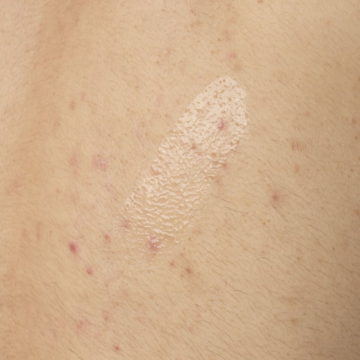 salicylic-acid-0-5-body-serum-v5 ORD-salicylic-acid-05-body-240ml-application.jpg