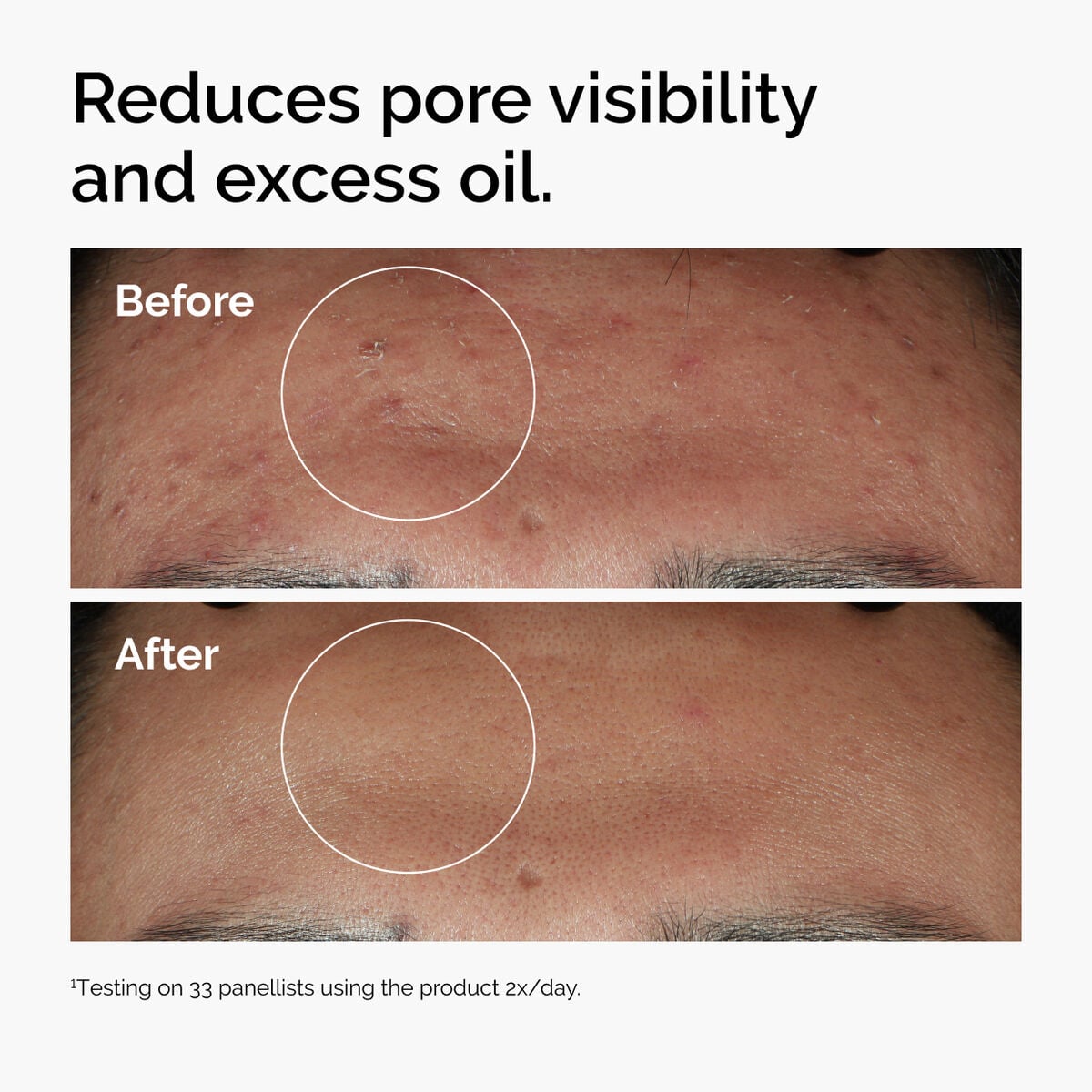 niacinamide-10-zinc-1-m3 ord-niacinamide-zinc-blemish-serum-before-after-pores.jpg