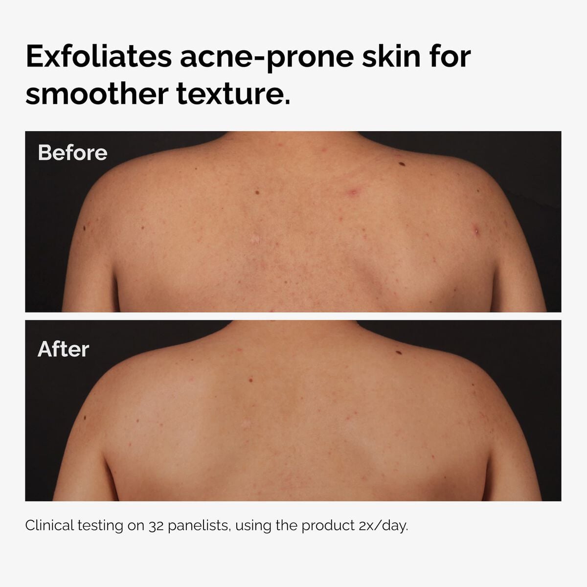 salicylic-acid-0-5-body-serum-v5 ord-salicylic-acid-body-serum-before-after-graphic-NA.jpg