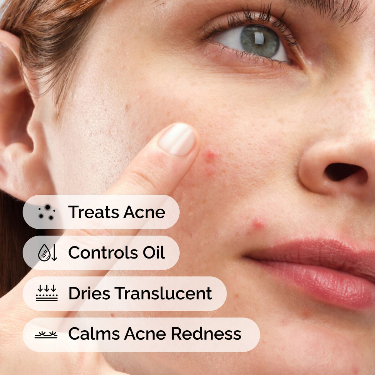 sulfur-10-powder-to-cream-concentrate-x8 ord-sulfur-10pct-powder-to-cream-concentrate-model-application-with-benefits-acne.jpg
