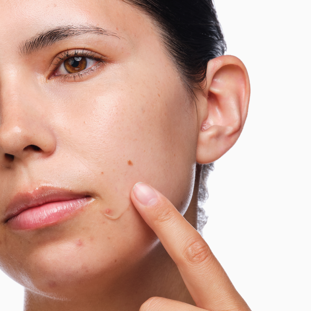 the-acne-set-r7 rdn-the-acne-set-application.png